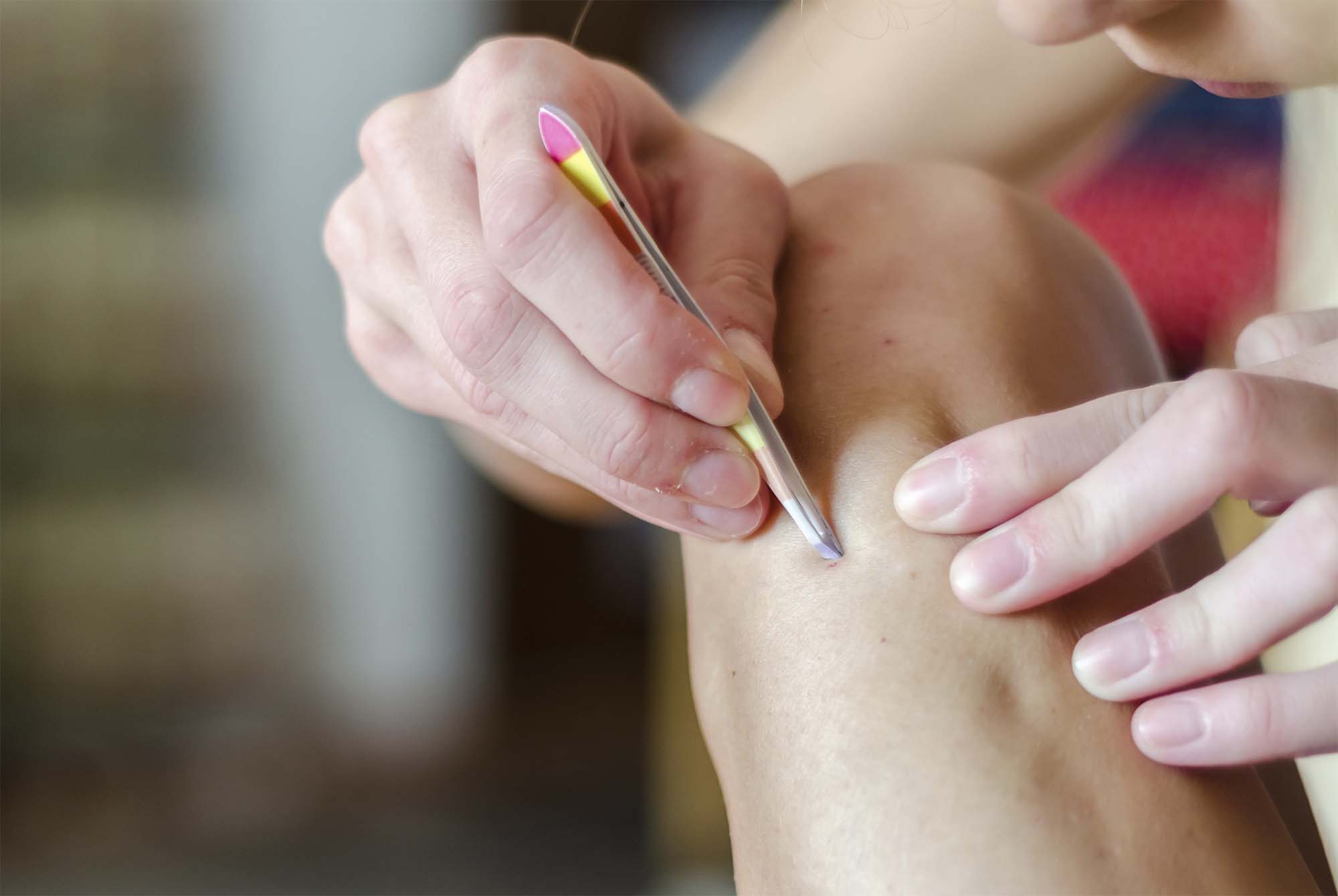 Sådan undgår du indgroede hår som mand – den komplette guide